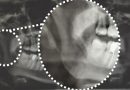 Diagnóstico Diferencial entre Disfunción Temporomandibular y Síndrome de Eagle