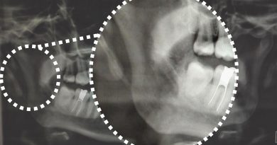 Diagnóstico Diferencial entre Disfunción Temporomandibular y Síndrome de Eagle Diagnóstico Diferencial entre Disfunción Temporomandibular y Síndrome de Eagle