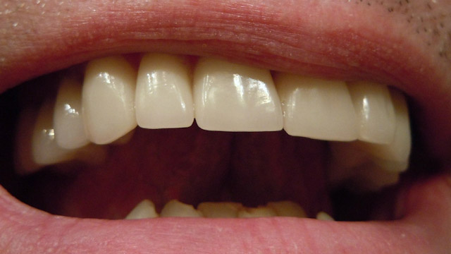 Nuevo Esmalte Dental Sintético