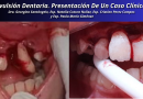 Avulsión Dentaria. Presentación De Un Caso Clínico