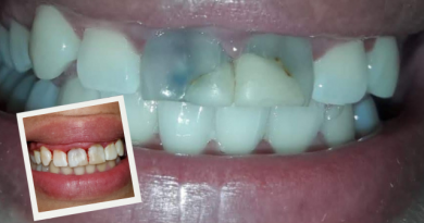 Retratamiento Endodóntico Complejo de Incisivos Superiores con Tornillos Intraradiculares Tipo Dentatus: Reporte de Caso y Reflexiones Clínicas Retratamiento Endodóntico Complejo de Incisivos Superiores con Tornillos Intraradiculares Tipo Dentatus: Reporte de Caso y Reflexiones Clínicas